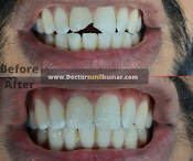 Before and after dental treatment result - unnamed (4).png